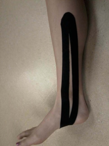 Périostite  Tibiale  (Medial Tibial Stress Syndrome)